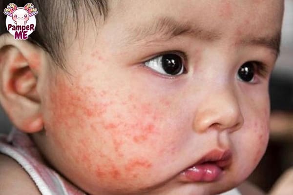 Các bệnh dị ứng thường gặp ở trẻ sơ sinh
